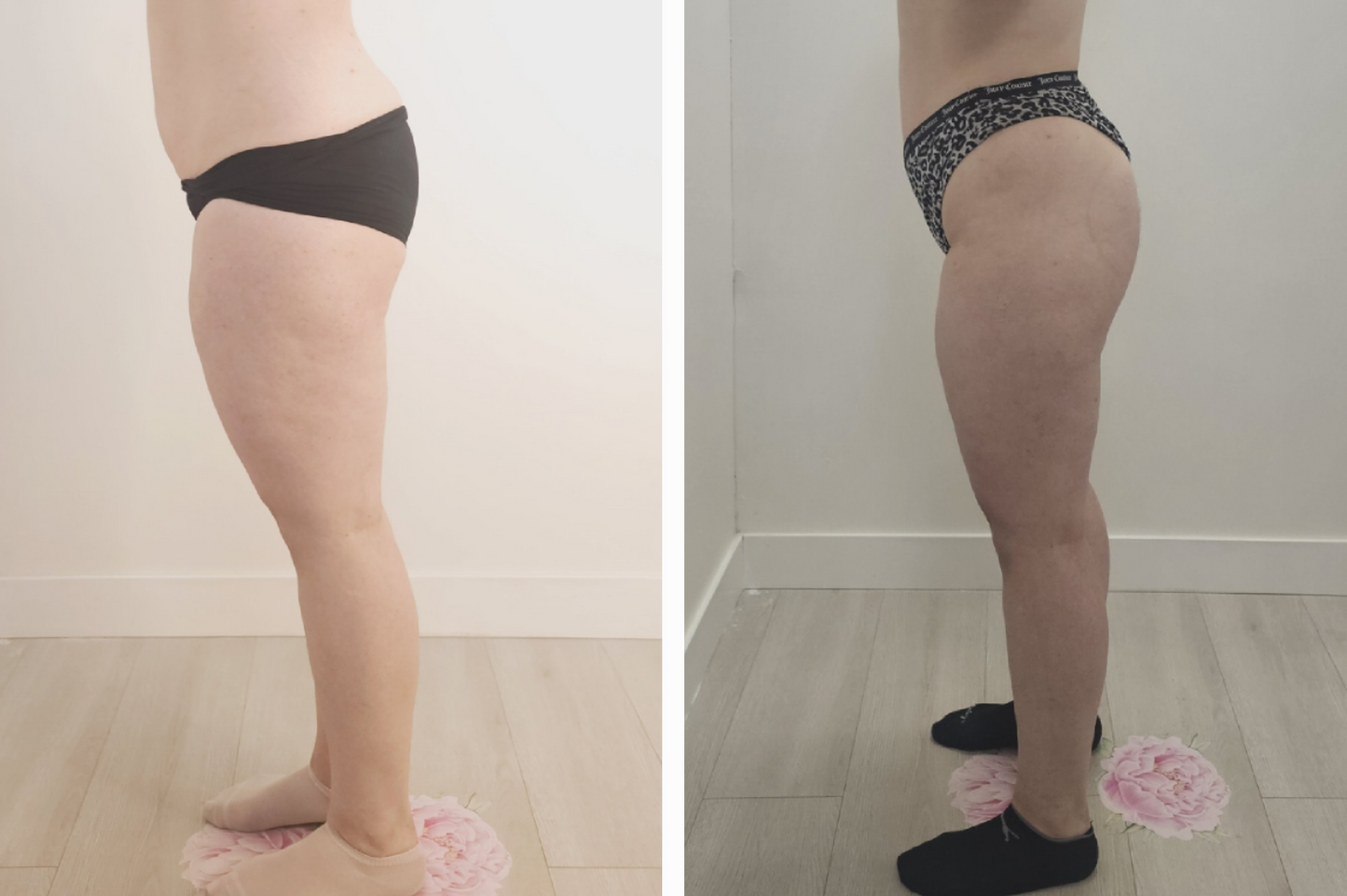 Body cellulite therapy OPT - 1